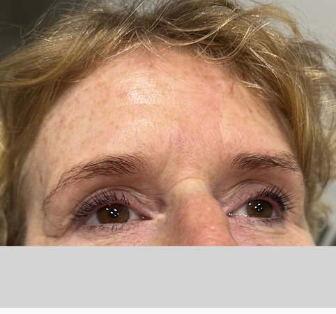 Forehead lines, softened. — after