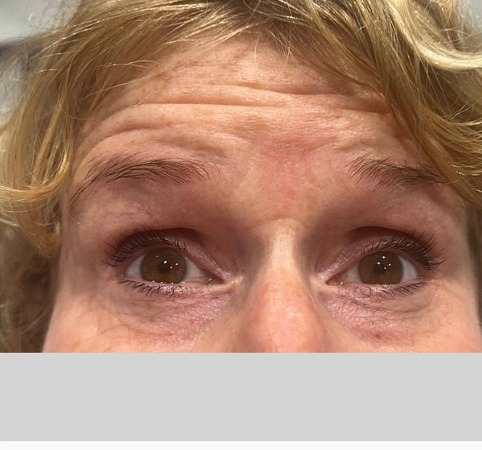 Forehead lines, softened. — before