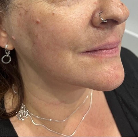 Face & neck HIFU lift. — after