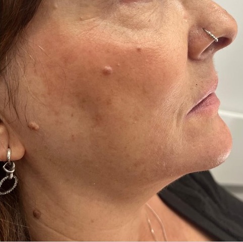 Face & neck HIFU lift. — before