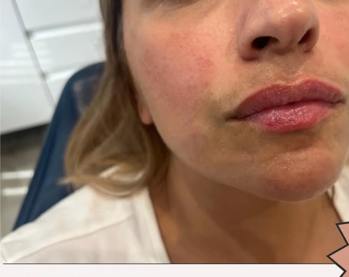 Lip enhancement — less is more. — after