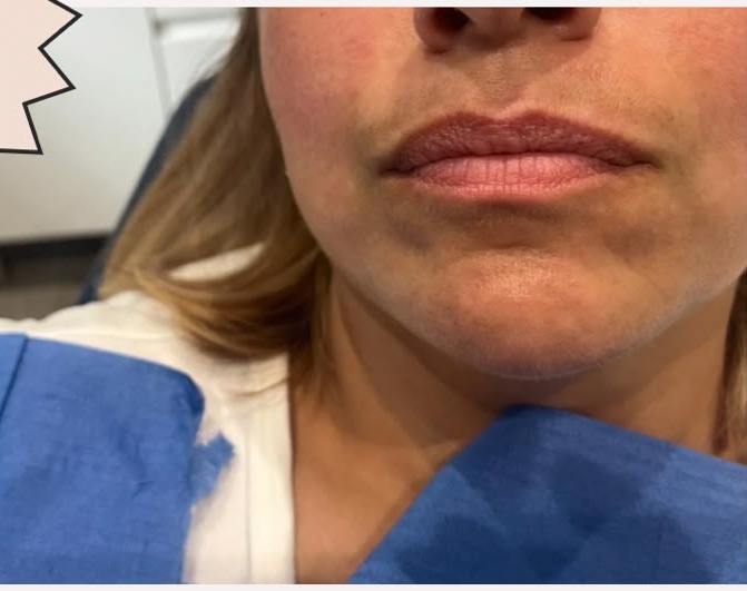 Lip enhancement — less is more. — before