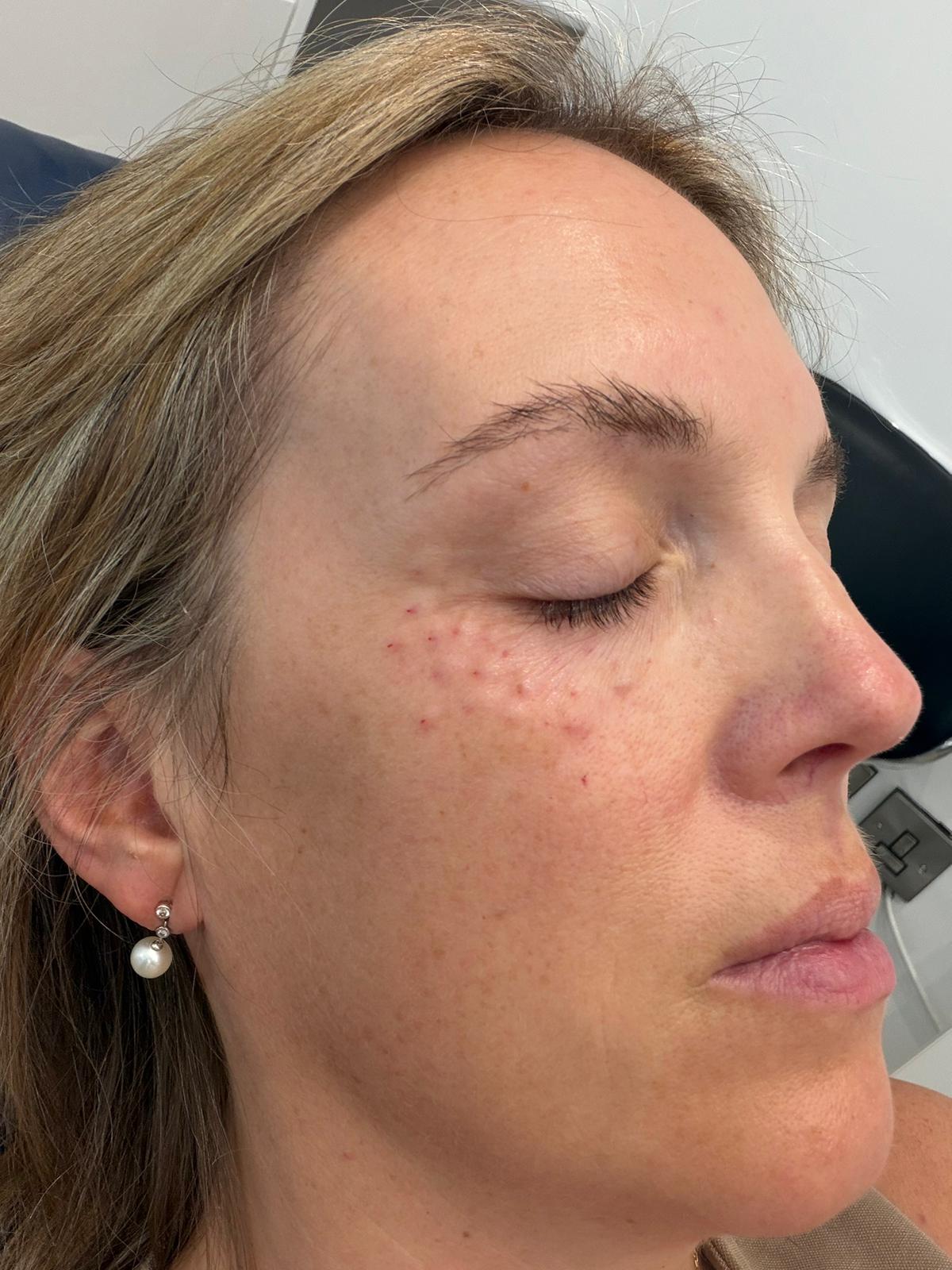 Tear trough rejuvenation. — after