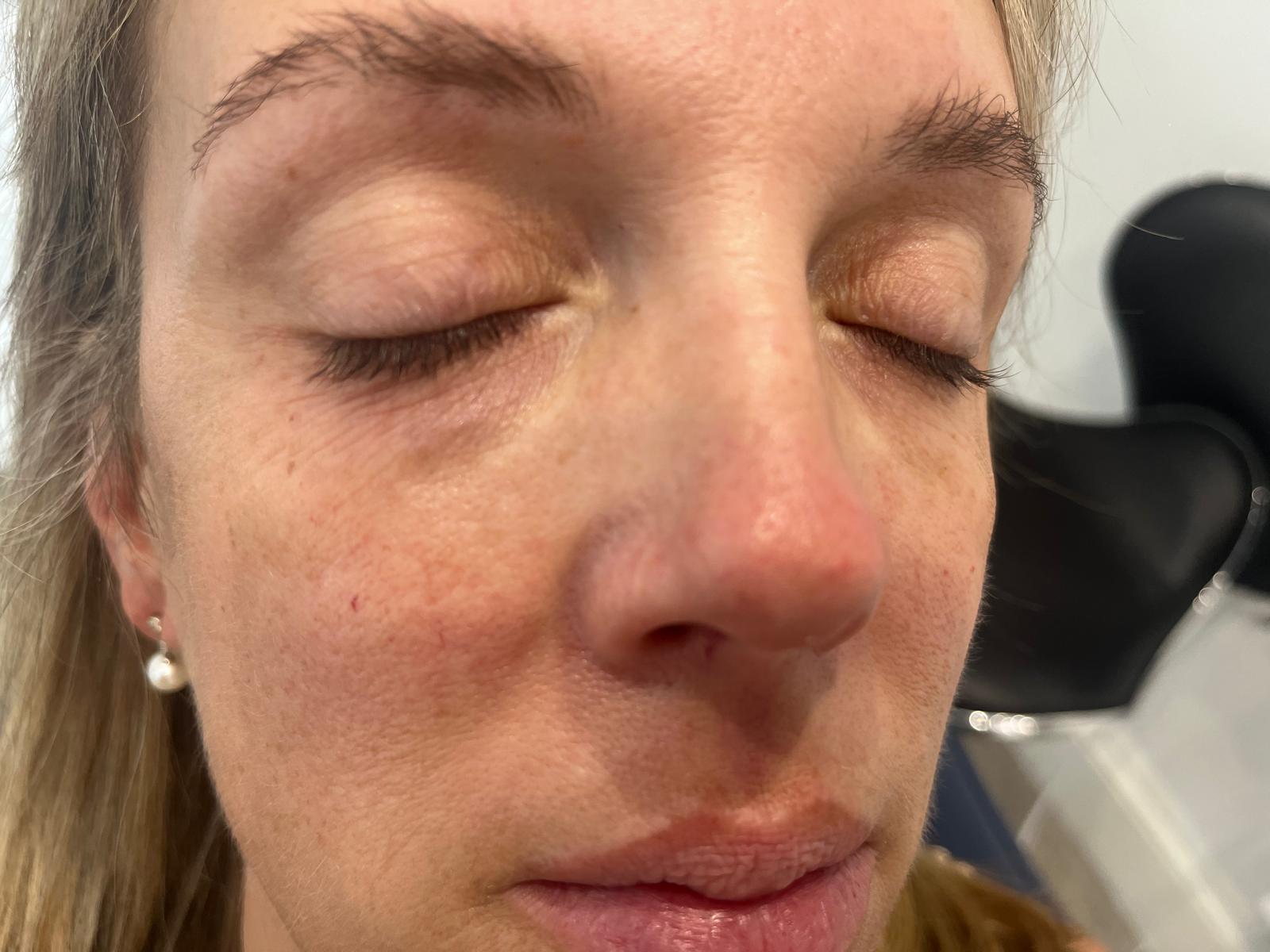 Tear trough rejuvenation. — before