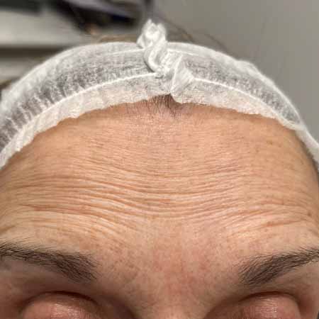 Anti-Wrinkles Before