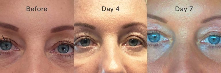 A client's experience of plasma service - photo comparing before, day 4 and day 7
