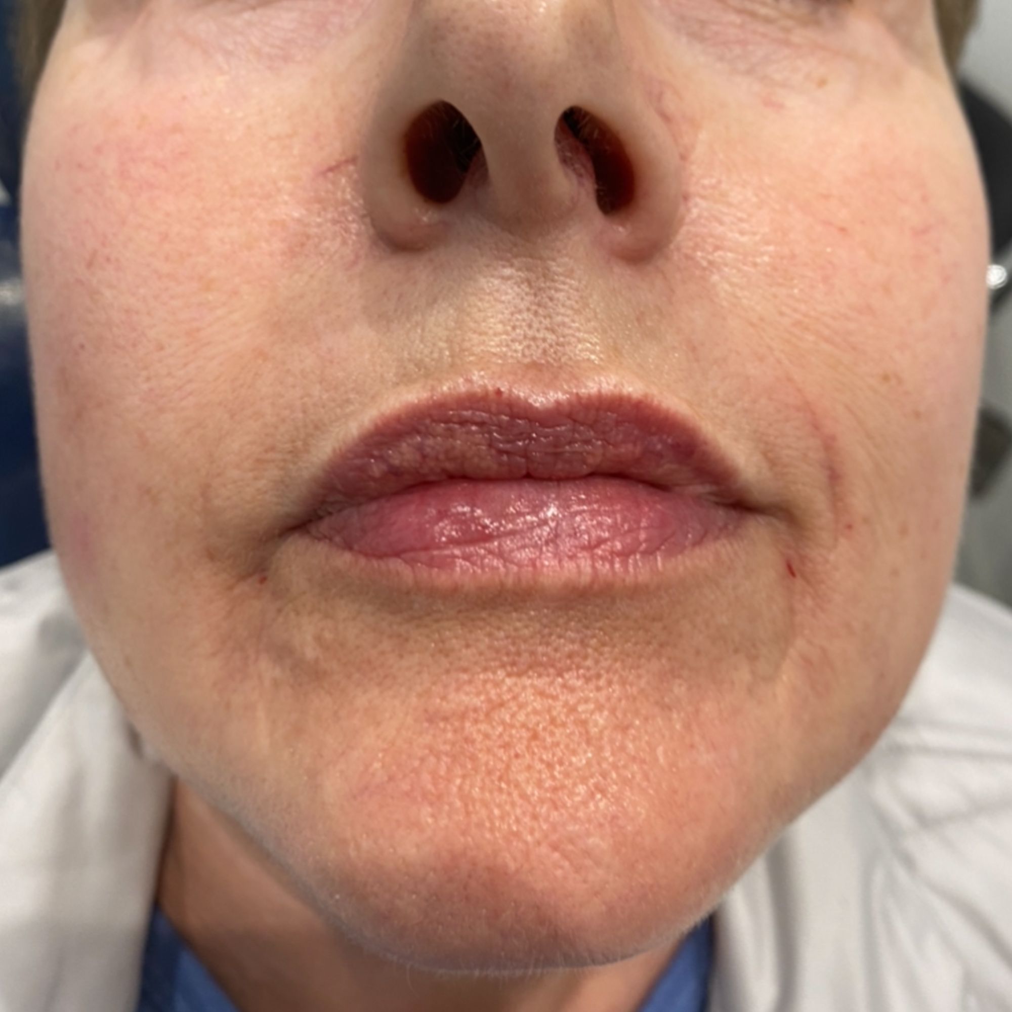 Lip-Filler-2-After