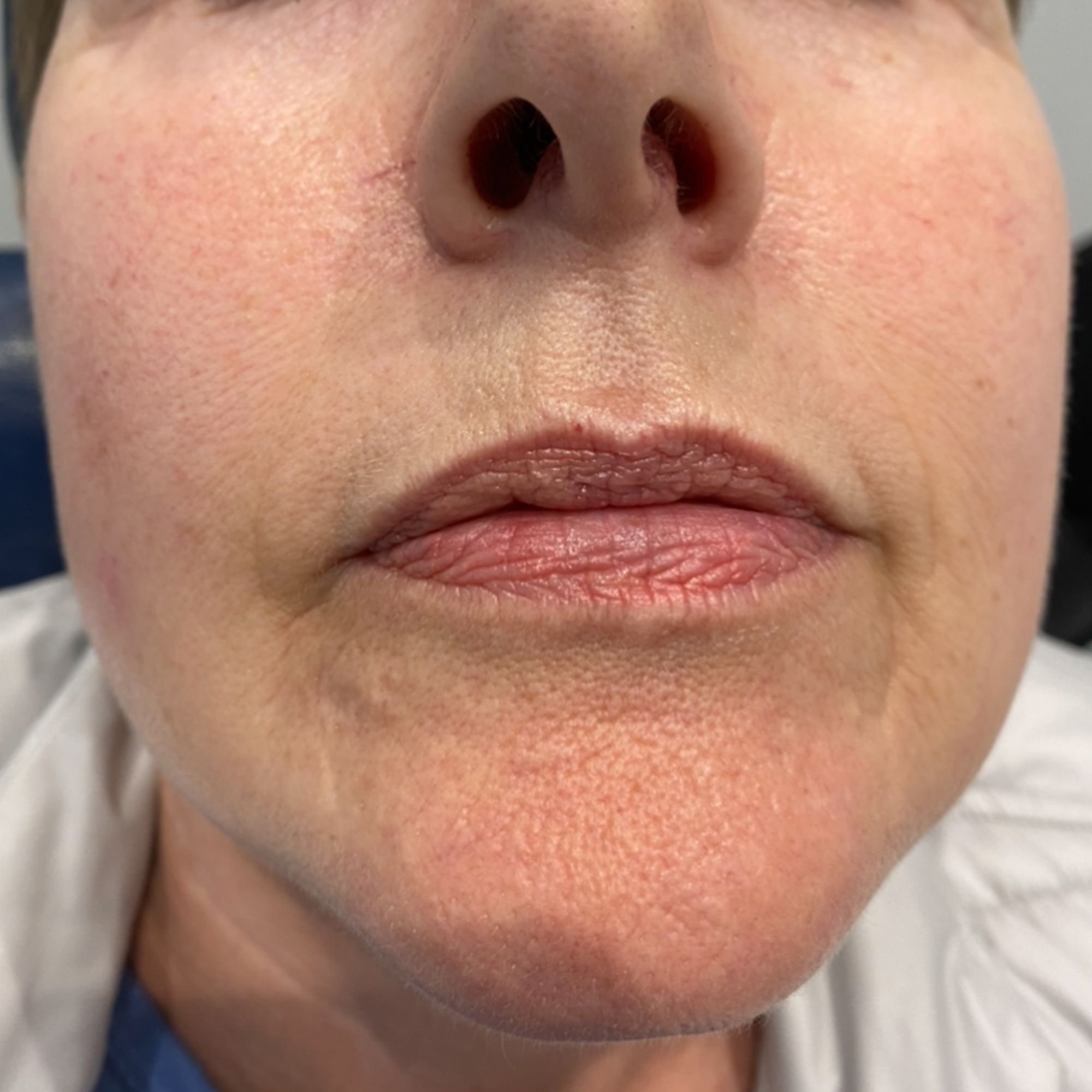 Lip-Filler-2-Before